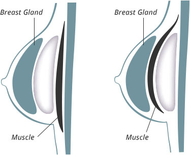 Your Guide to Breast Augmentation in Cary, NC