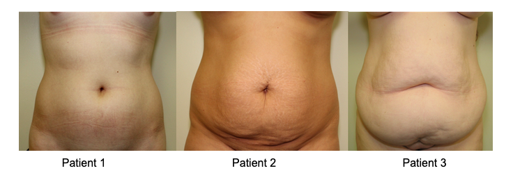 Liposuction vs Tummy Tuck: What's Right For Me?