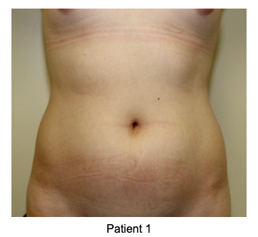 Liposuction vs. Tummy Tuck