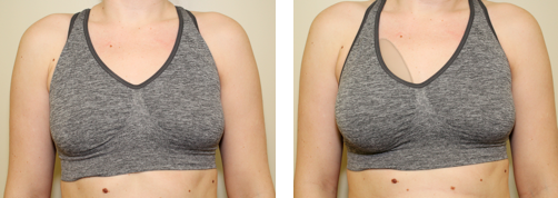 Patient trying on breast sizers