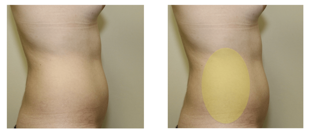 Will My Stomach Be Flat After Abdominoplasty?