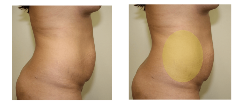Will My Stomach Be Flat After Abdominoplasty