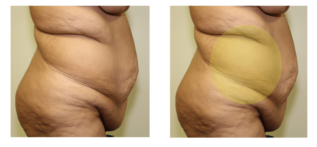 Abdominoplasty or Liposuction: What's Better For Getting a flat tummy?