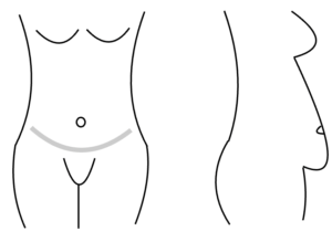Graphic showing front and side views of the position of the infra-umbilical fold below the belly button and above the groin