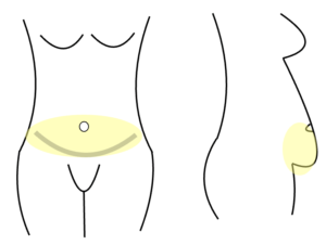 Graphic showing front and side views of where the tissue will be removed from the lower abdomen during the tummy tuck