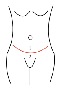 Graphic showing the front view of the belly button covered by the flap created during the tummy tuck procedure