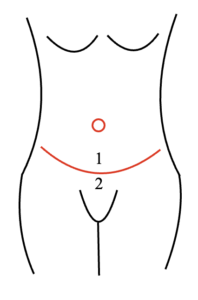 Graphic of front view of belly button and infra-umbilical fold incision locations
