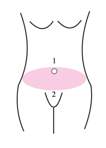 Graphic showing a front view of the position of the belly button in relation to the tissue that is removed during the tummy tuck