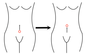 Graphic showing the front view of a too-low belly button being elevated to the correct position