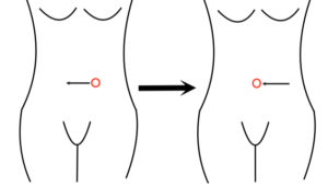 Graphic showing the front view of an asymmetrical belly button being moved to the midline