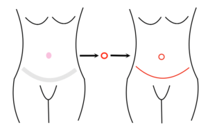 Graphic showing a front view of the belly button being removed from the abdominal wall and replaced in the normal position