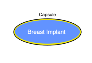 Diagram of a breast implant, inserted. There is no longer space with air around the implant.