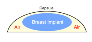 Diagram of a breast implant, inserted with space containing air around it